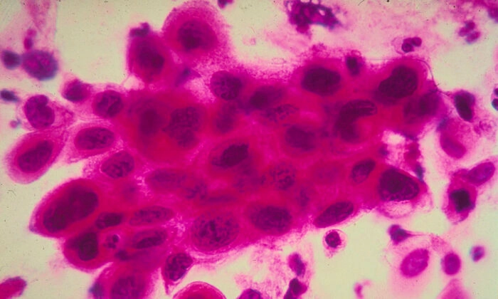 Cancer-Cells-dr-jose-nasser-aquera-700x420