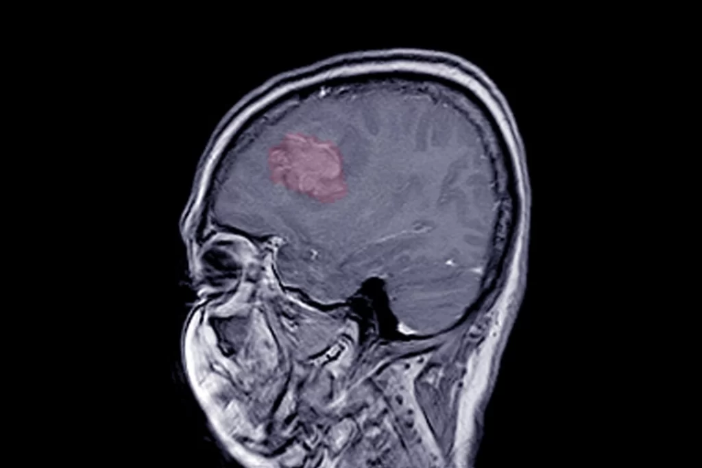 progesterona-cancer-cerebro-dr-jose-nasser-aquera