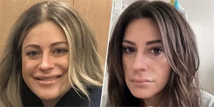 mulher-ozempic-face-dr-jose-nasser-aquera
